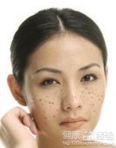 為什麼女性臉上愛長色斑？