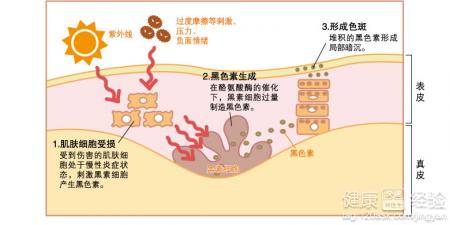 色斑和雀斑的區別?