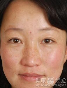 雀斑有什麼好的根治方法