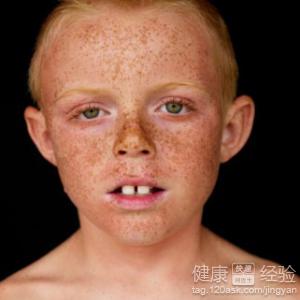10歲男孩臉上長雀斑怎麼治好呢？