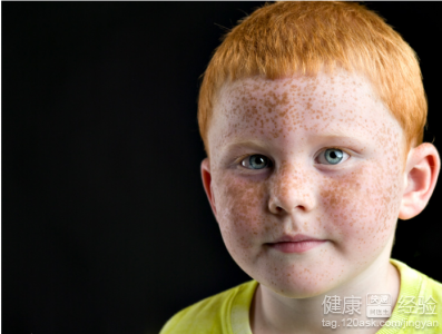 10歲男孩臉上長雀斑怎麼治？