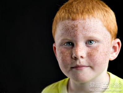 如何快速治療小男孩臉上的雀斑？