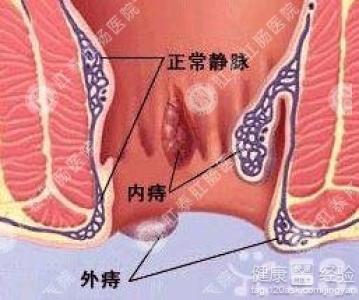 術後痣瘡的調理方法有哪些