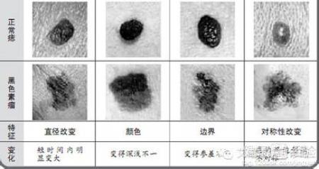 疣狀痣如何預防