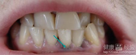 口腔裡長了痣怎麼回事