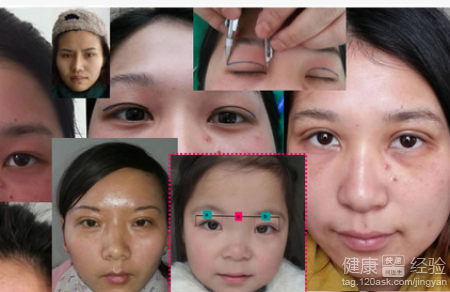 美容手術後切口愈合過程是怎樣的？