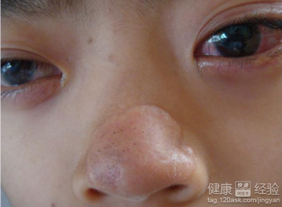 鼻子上長痘痘是什麼原因