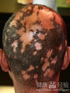 斑禿的幾個治療方法