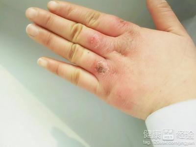 凍瘡是由於皮膚哪一部分受損而引起的