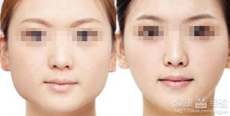 瘦臉針一般可以維持多久?