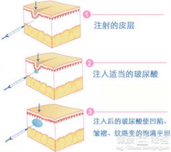 注射伊維蘭除皺需要注意什麼