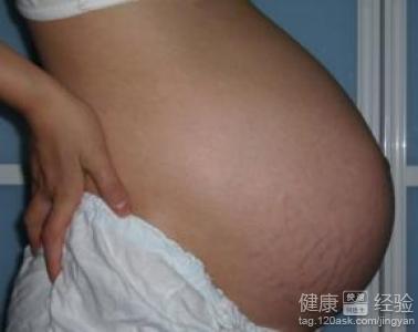 有什麼辦法可以去除孕後的妊娠紋