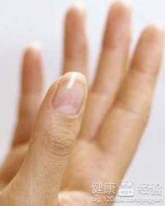 手指甲上出現白點怎麼回事？