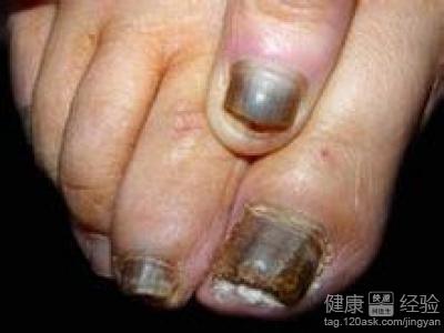 灰指甲怎樣會傳染