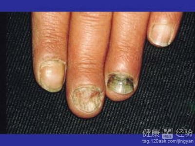 灰指甲的治療方法，你知道幾個呢？