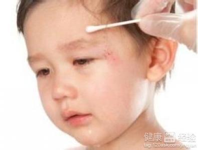 用陳年山茶油輔助治療孩子皮膚外傷不留疤痕