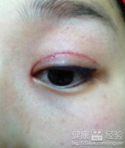 如何預防雙眼皮術後疤痕出現?