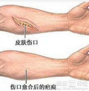 剖腹產留下的疤痕如何修復呢