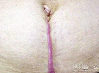 剖腹產疤痕增生怎麼辦