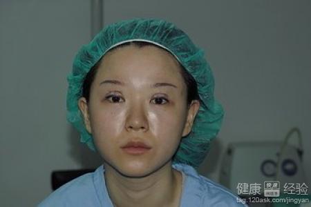 疤痕體質可以做雙眼皮手術嗎