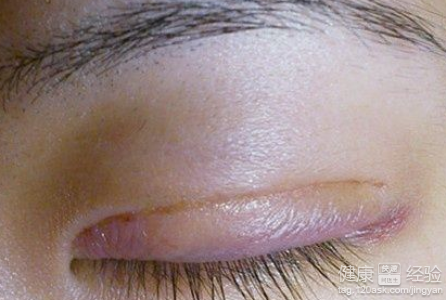 割雙眼皮留下的疤痕可以使用什麼藥物