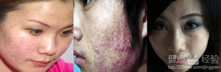 治療青春痘濕疹的祛疤的藥有什麼