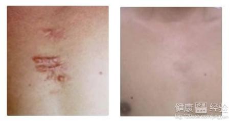兩側腋下的增生性疤痕用什麼方法好
