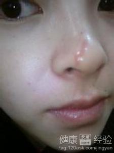 鼻子上的疤痕修復治療什麼方法可靠