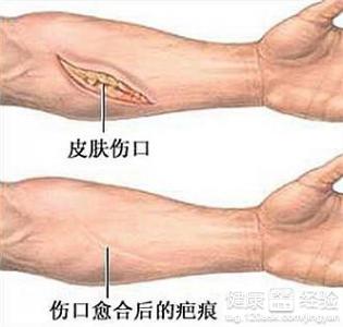 燙傷疤痕修復用什麼藥物呢