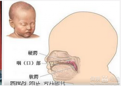 唇裂手術後疤痕修復選擇什麼方法