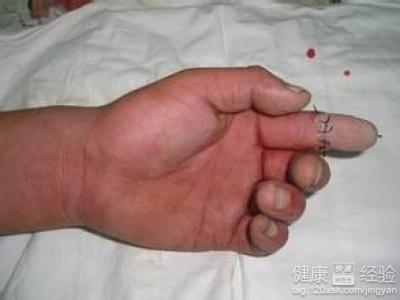 斷指再植術後的疤痕修復及指甲再植的過程