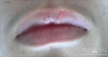 嘴唇疤痕修復術後怎樣保養