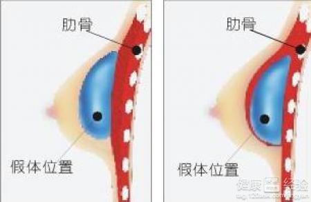 做隆胸手術好嗎