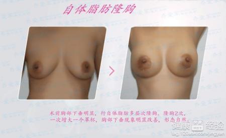 假體隆胸會影響哺乳嗎