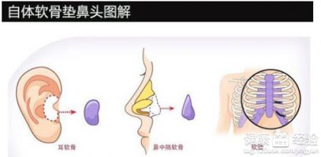 自體軟骨隆鼻術多少錢