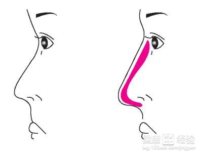 韓式隆鼻的副作用