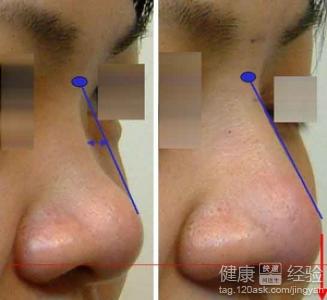 固體硅膠隆鼻的排異有哪些
