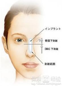 韓式隆鼻跟平常的隆鼻手術有什麼區別