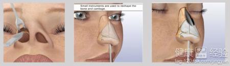 隆鼻失敗的症狀和原因