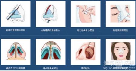 隆鼻手術的程序是什麼