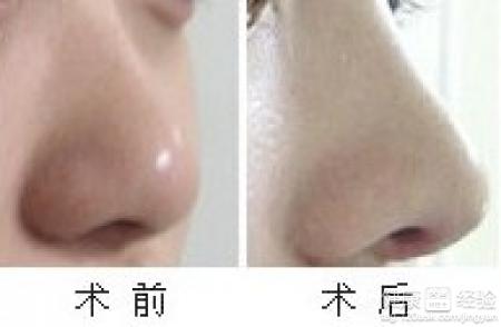 韓式納米仿真隆鼻術是怎樣的