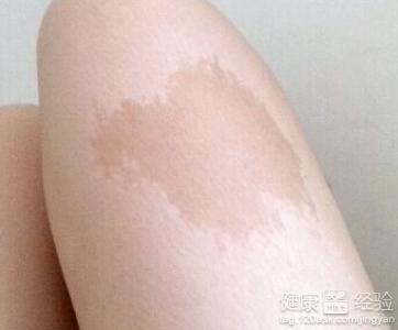 嬰兒腿上胎記的危害