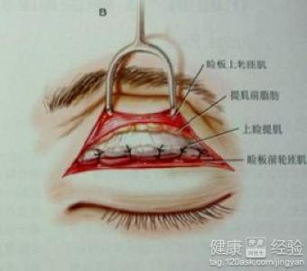 全切雙眼皮能修復嗎