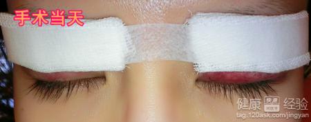 割雙眼皮修復過程圖