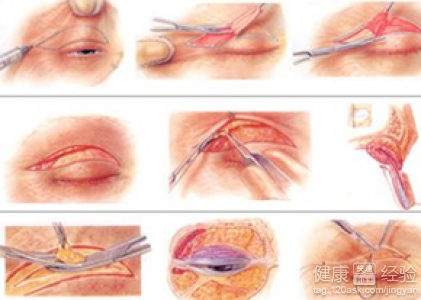 全切雙眼皮修復要錢嗎