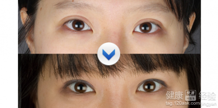 雙眼皮可以修復嗎