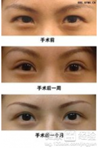 韓式三點雙眼皮修復術