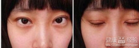 雙眼皮過寬能修復嗎