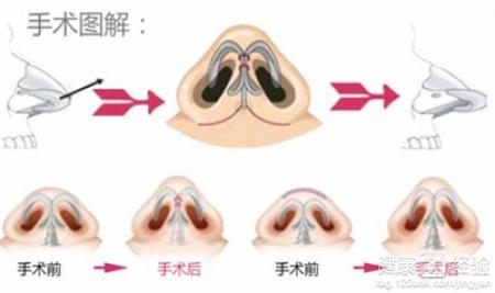 鷹鉤鼻矯正的優勢