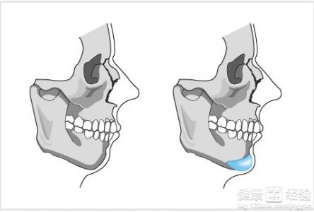 膨體墊下巴會移位嗎